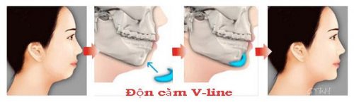 Độn cằm v line