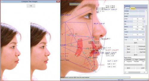Độn cằm v line
