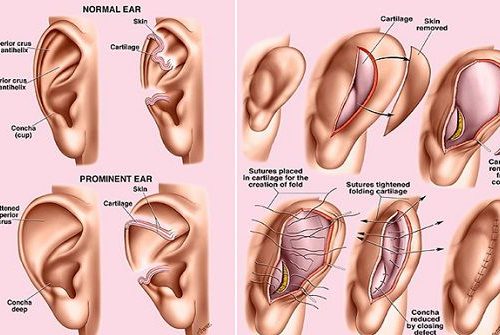 Nên lựa chọn phương pháp nâng mũi nào