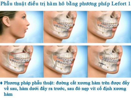 Phẫu thuật hàm hô móm
