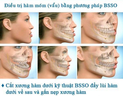 Phẫu thuật hàm hô móm