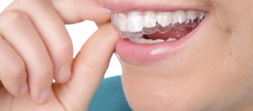 Phẫu thuật hàm hô móm