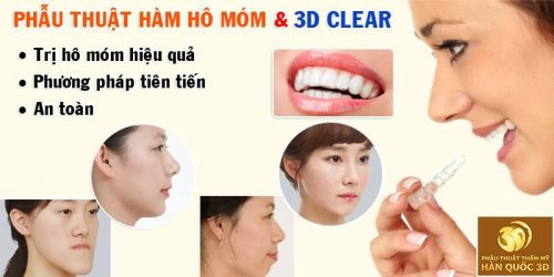 Phẫu thuật hàm hô móm